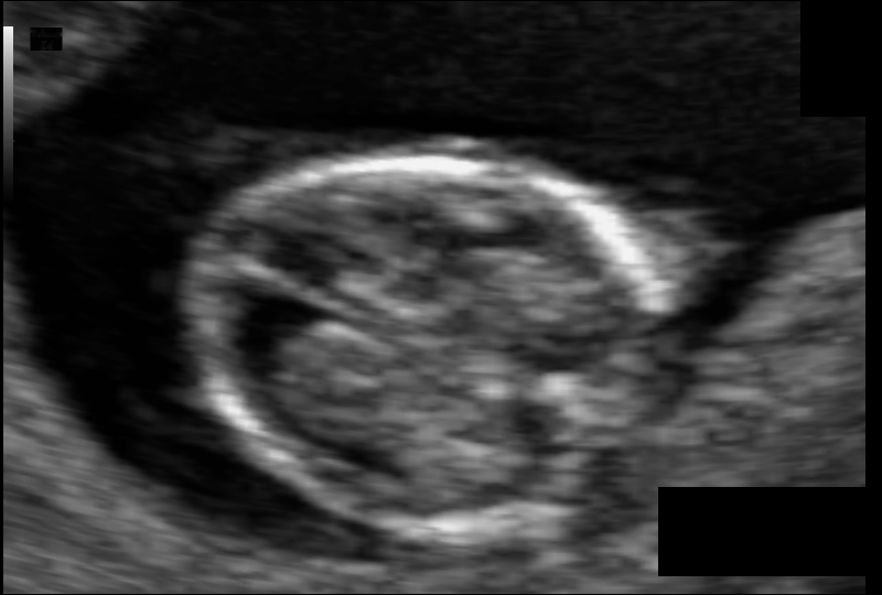 neonatal ultrasound data from a study be Mahmood Alzubaidi et al.